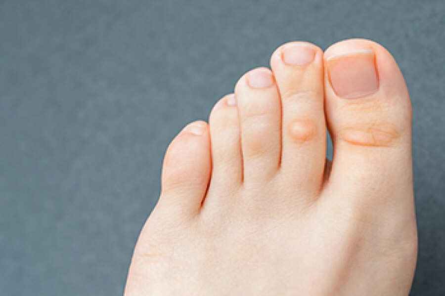 Preventing Corns and Calluses: Foot Care Tips from Dr Foot Podiatry Clinic